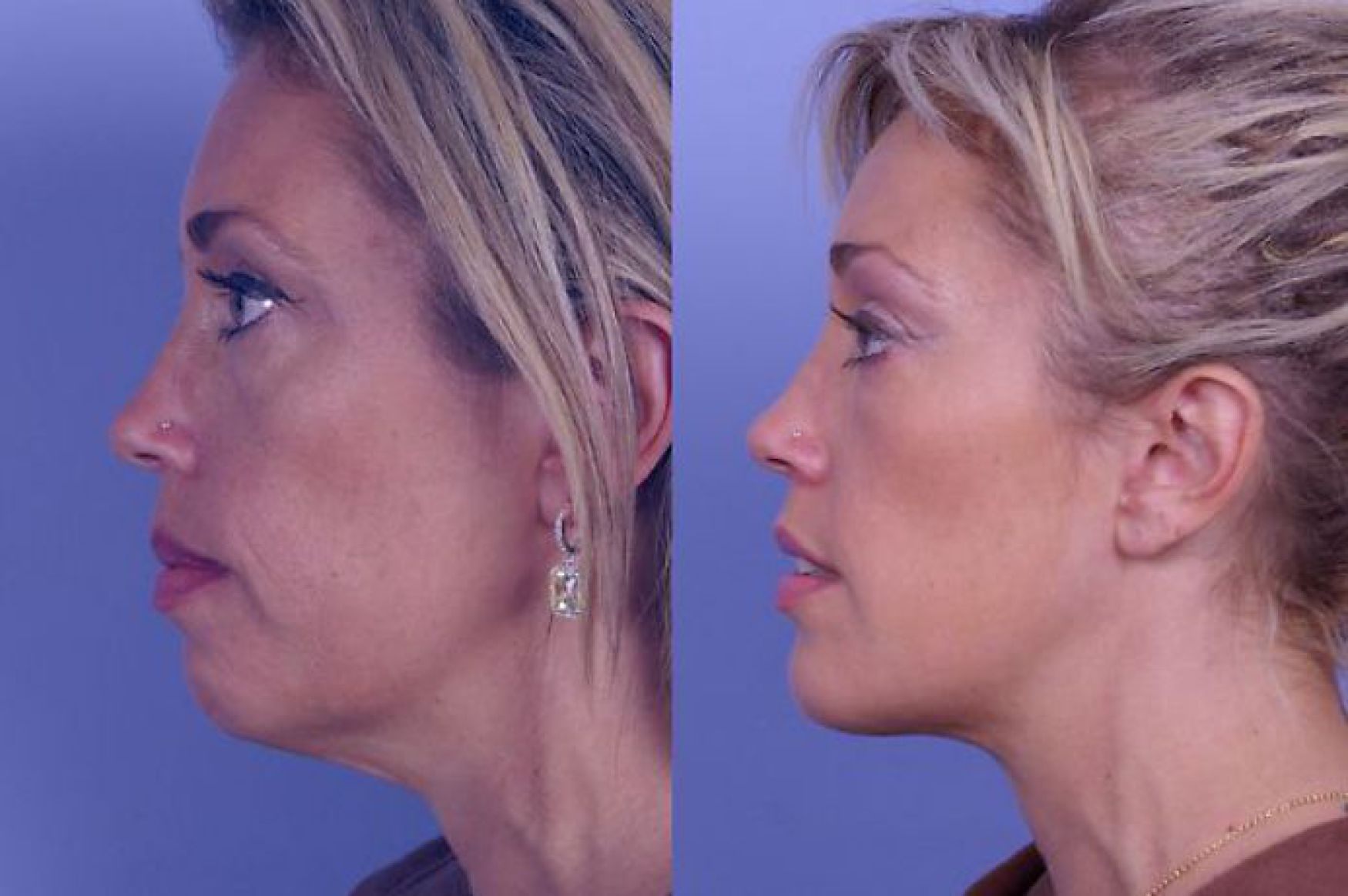 Chin Augmentation Before And Afters Raval Facial Aesthetics Denver